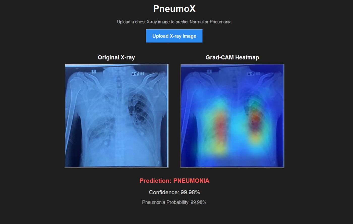PneumoX research interface showing a chest X-ray and Grad-CAM heatmap